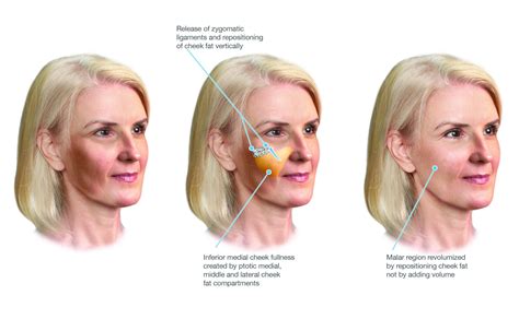 bichats fettpute|The Surgical Anatomy and the Deep Plane Thread Lift of the .